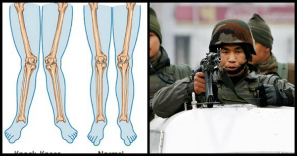 How To Heal Knock Knees For Indian Army Recruitment- Five Simple Ways